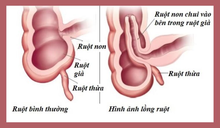 Triệu chúng và nguyên nhân của bệnh lồng ruột cấp ở trẻ