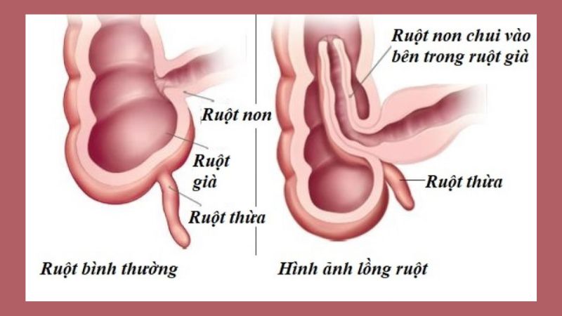 Triệu chúng và nguyên nhân của bệnh lồng ruột cấp ở trẻ