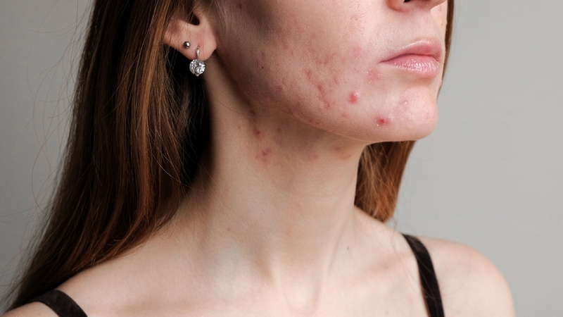 Mụn là một trong các biến chứng trên da khi mắc bệnh viêm ruột mãn tính 