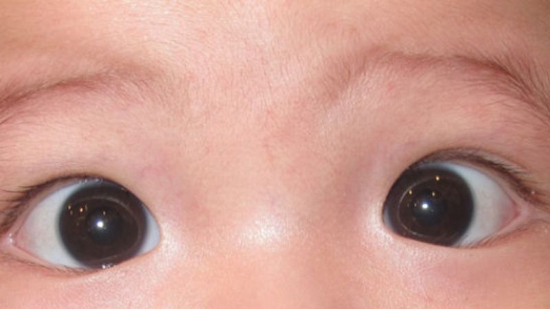 Biểu hiện lác mắt ở trẻ