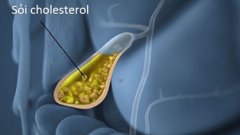 Phần lớn sỏi mật là loại sỏi cholesterol