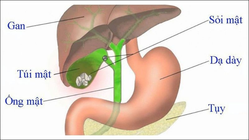 Cảnh báo nguyên nhân sỏi mật phổ biến hàng đầu bạn nên biết