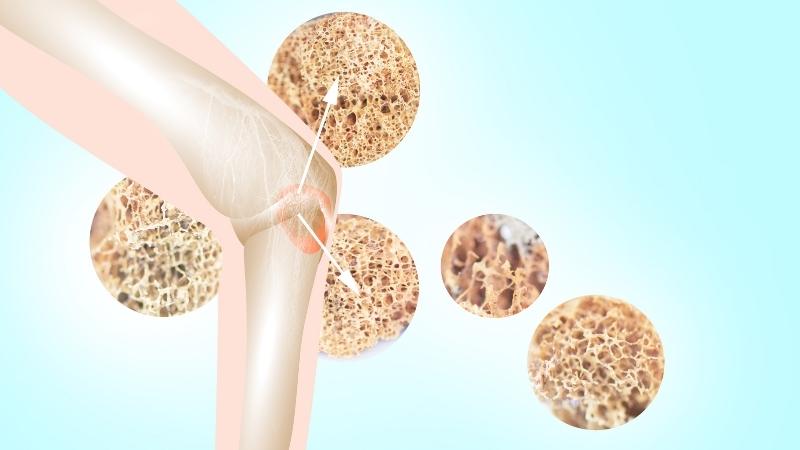Pocket top 5 natural herbs to support osteoporosis treatment