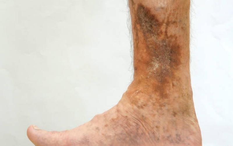 Chân của người bị suy giãn tĩnh mạch dễ xuất hệt các vết loét do da thiếu oxy và dưỡng chất