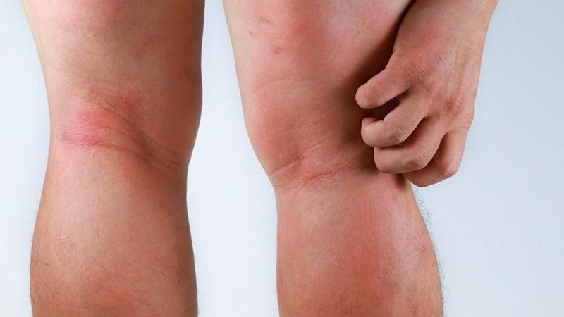 Tình trạng viêm da trên chân của người bị suy giãn tĩnh mạch là nguyên nhân xuất hiện các vết ban đỏ