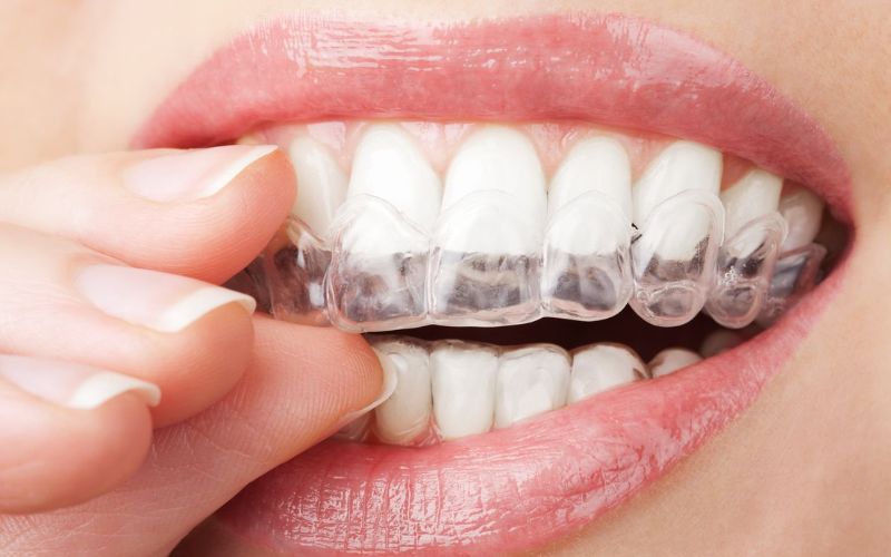 What are clear braces? Pros and cons of clear braces