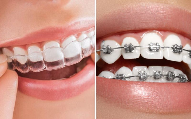 What Are Clear Braces Pros And Cons Of Clear Braces 