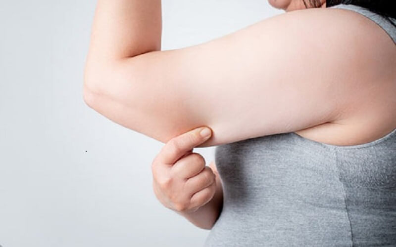 Cánh tay bị thừa mỡ là dấu hiệu của bệnh béo phì và chỉ số BMI cao