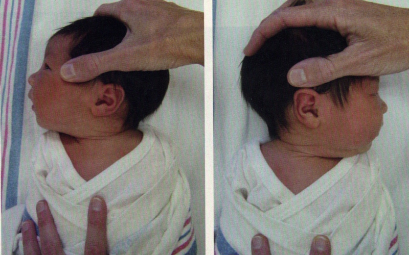 Dấu hiệu của hội chứng đầu bẹt ở trẻ