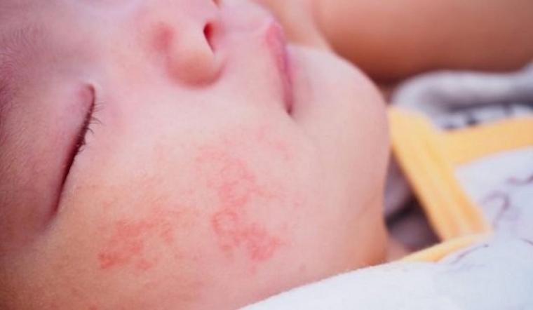 Nấm da ở trẻ sơ sinh là bệnh gì, cách điều trị bệnh nấm da