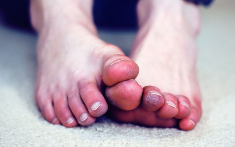 Người mắc các bệnh về da chân không nên ngâm chân mỗi ngày