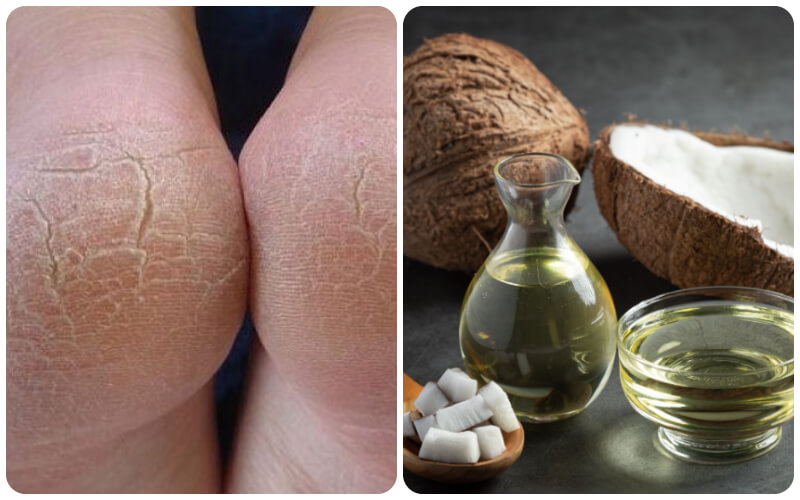 Treating cracked heels with pure coconut oil