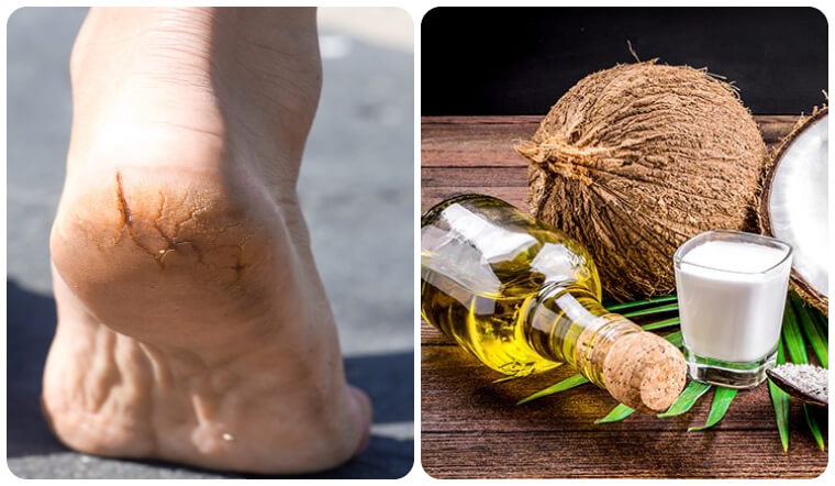 6 cách trị nứt gót chân bằng dầu dừa tại nhà, hiệu quả nhanh