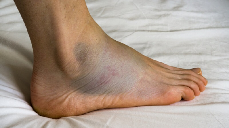 Phù chân ở người già có nguy hiểm không? Nguyên nhân và cách điều trị