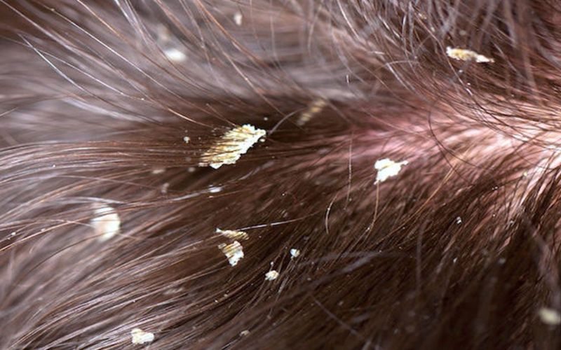 Tại sao da đầu khô tróc vảy vào mùa đông? Cách trị hiệu quả
