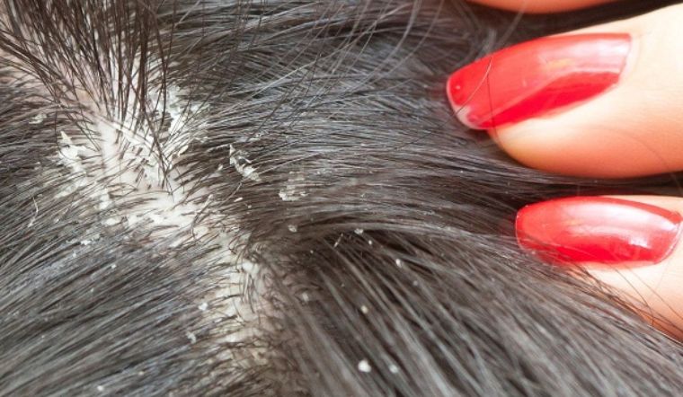 Tại sao da đầu khô tróc vảy vào mùa đông? Cách trị hiệu quả