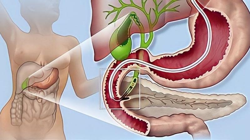 Nội soi mật tụy ngược dòng vừa có tác dụng khảo sát đường mật vừa có hiệu quả điều trị sỏi mật