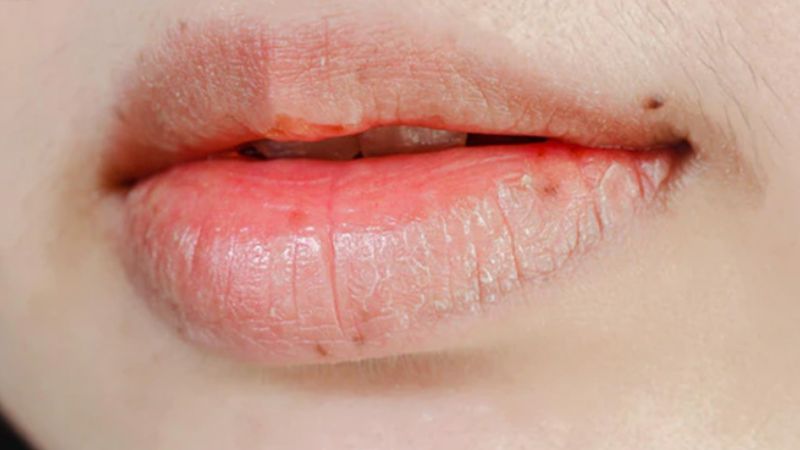 Dry Lips