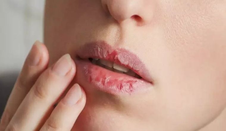 Môi khô nứt nẻ quanh năm là bệnh gì? Cách điều trị hiệu quả 