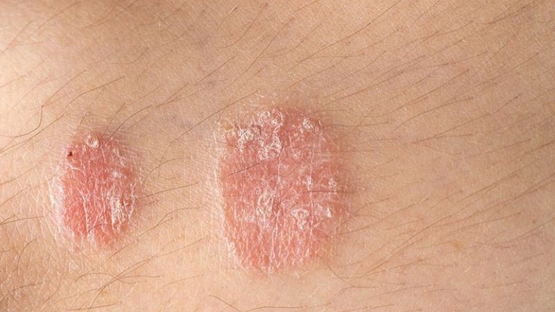 Thổ phục linh có thể hỗ trợ điều trị bệnh vảy nến