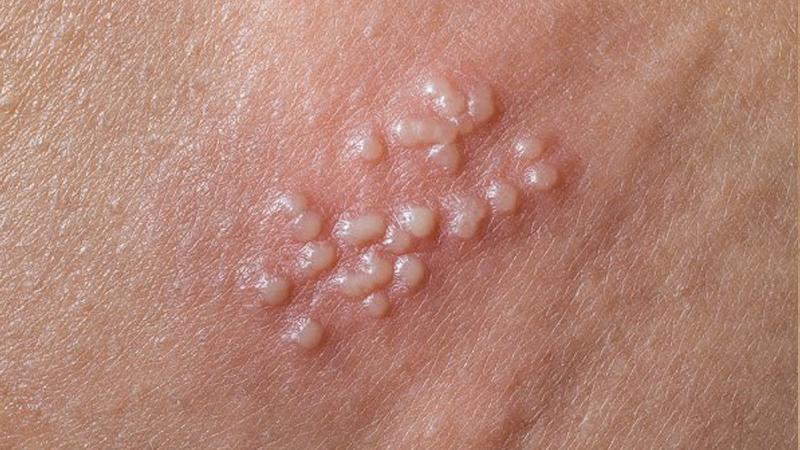Thổ phục linh có mặt trong một số bài thuốc giúp điều trị lậu
