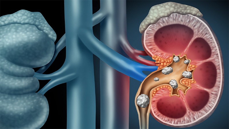 Mướp đắng giúp điều trị sỏi thận