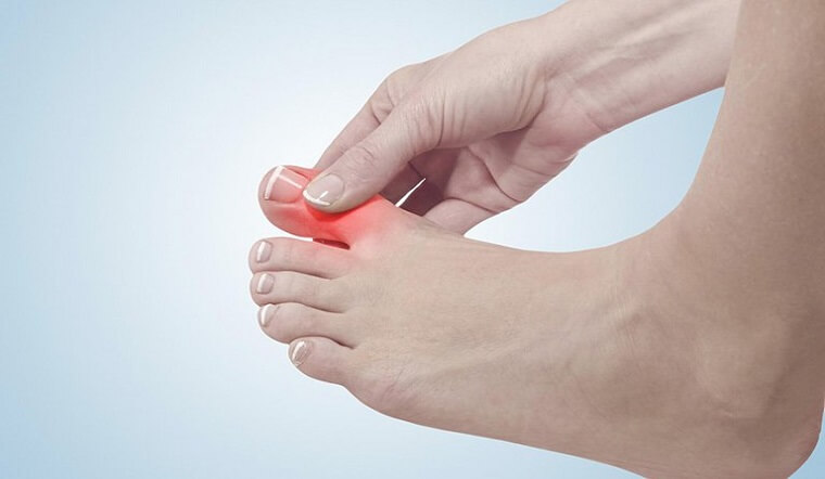 Bệnh gout (gút) là gì? Nguyên nhân, triệu chứng và cách phòng ngừa