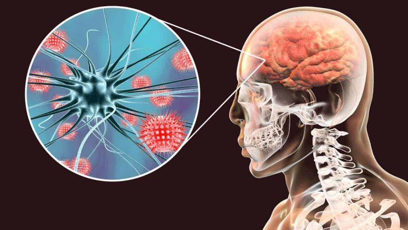 Viêm màng não có nguy hiểm không? 4 biến chứng viêm màng não
