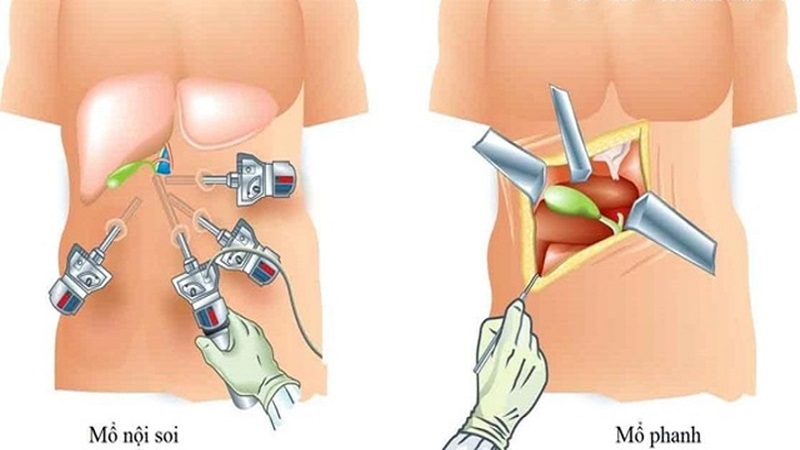 Tiêu chảy sau khi cắt bỏ túi mật