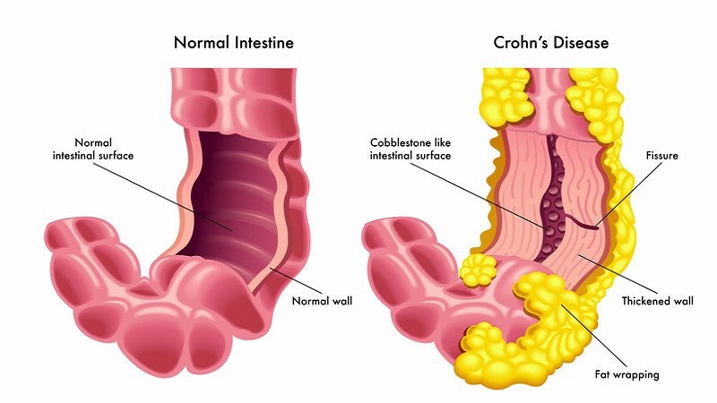 Tiêu chảy kéo dài bởi bệnh Crohn