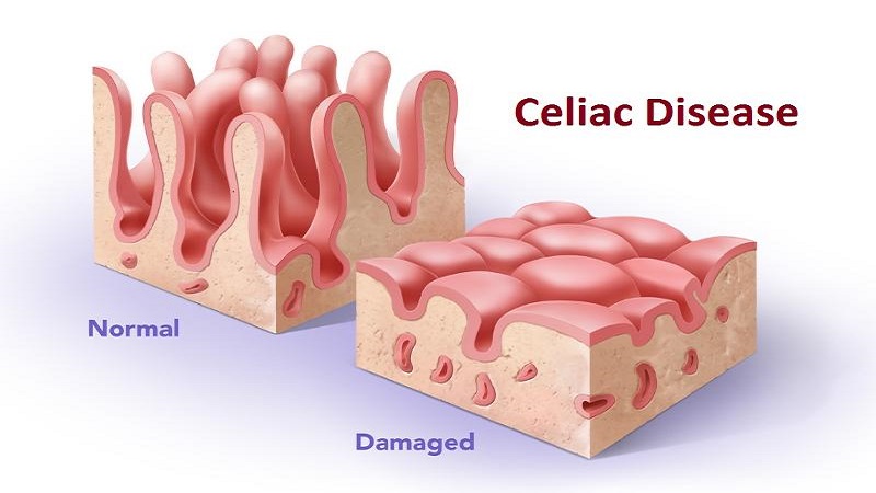 Tiêu chảy kéo dài gây ra bởi bệnh Celiac