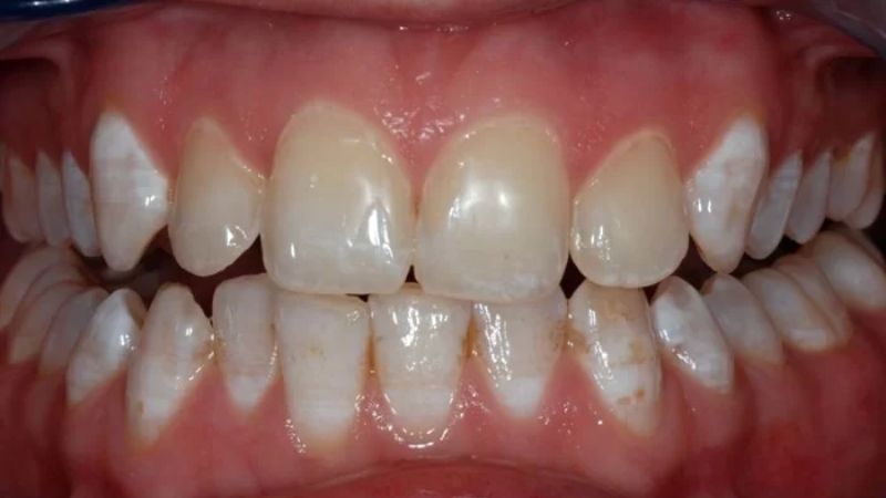 Răng bị nhiễm fluor ở trẻ có thể tẩy trắng được hay không?