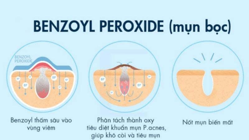 bezoyl peroxide khi dùng chung với vitamin C sẽ gây kích ứng nghiêm trọng
