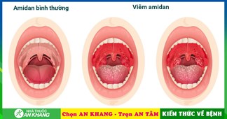 Amidan có nguy hiểm không? Các biến chứng viêm Amidan thường gặp