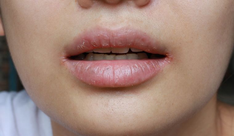 Bị khô miệng do đâu? Nguyên nhân và cách phòng ngừa khô miệng kéo dài 