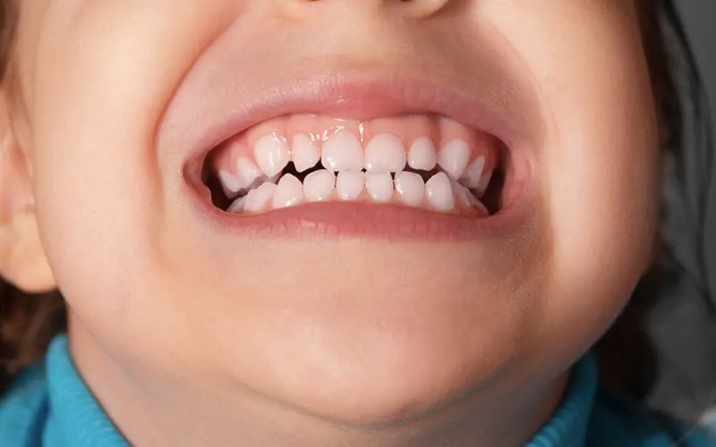 Trẻ bị nghiến răng khi ngủ là thiếu chất gì?
