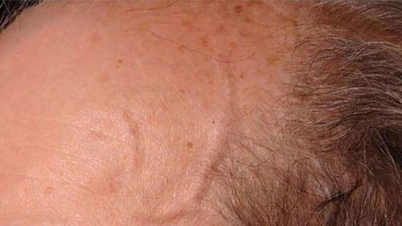 Viêm động mạch tế bào khổng lồ
