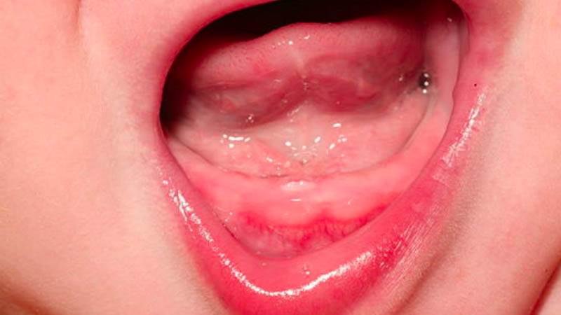 Răng hàm dưới mọc trước ảnh hưởng đến sức khỏe của trẻ