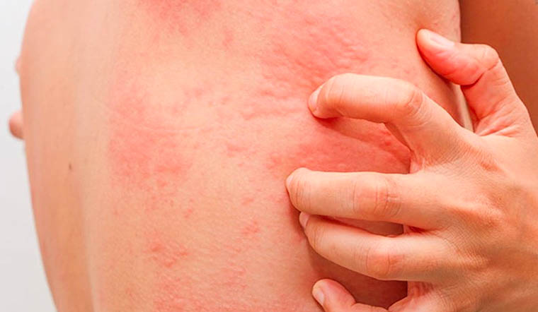 Dị ứng thịt bò: Nguyên nhân, triệu chứng và cách phòng ngừa 