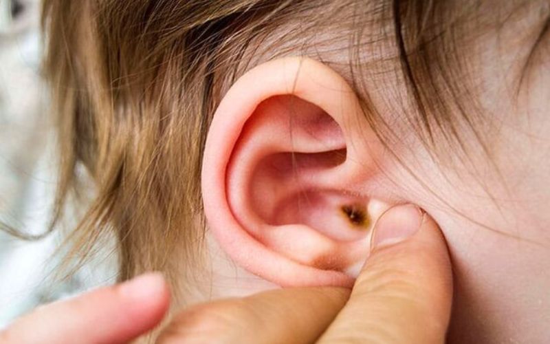 Viêm tai ngoài ở mức độ nhẹ