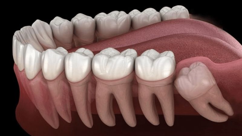 Răng khôn mọc ngầm là gì? Có nên nhổ răng khôn mọc ngầm hay không?