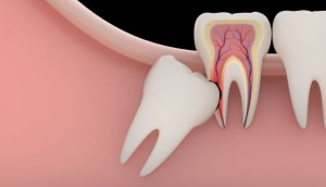 Răng khôn mọc ngầm là gì? Có nên nhổ răng khôn mọc ngầm hay không?