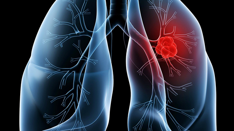 Viêm khớp dạng thấp có thể gây viêm trong phổi