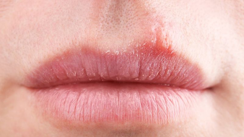 Có nhiều nguyên nhân gây dị ứng son môi