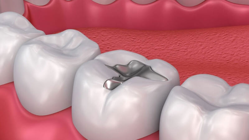 Bảo vệ chỗ trám