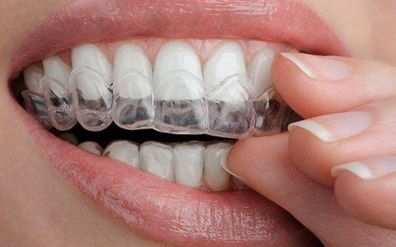 Máng tẩy trắng răng có hiệu quả không? Ưu nhược điểm và cách sử dụng