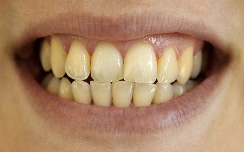 Đối tượng có thể tẩy trắng răng bằng máng ngậm