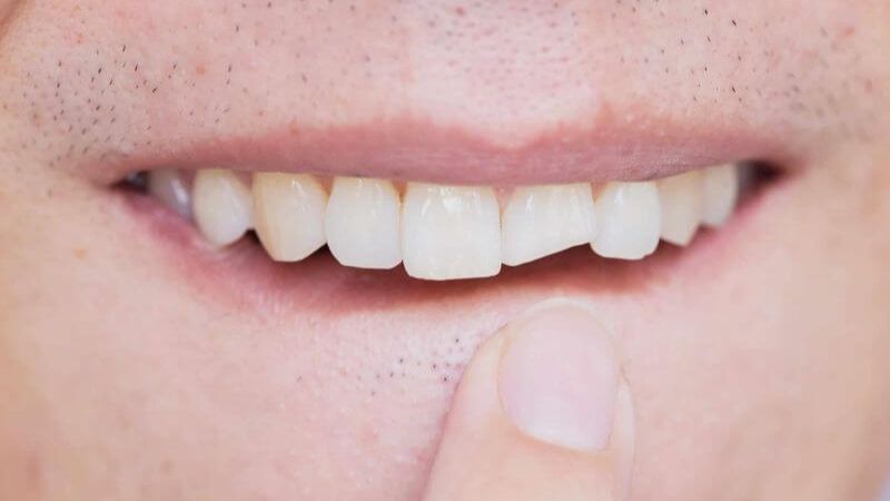 Đây là 6 nguyên nhân khiến răng sứ bị mẻ và cách xử trí khi gặp phải