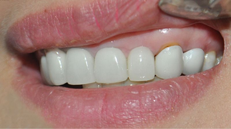 Răng sứ không được gắn khít vào cùi răng