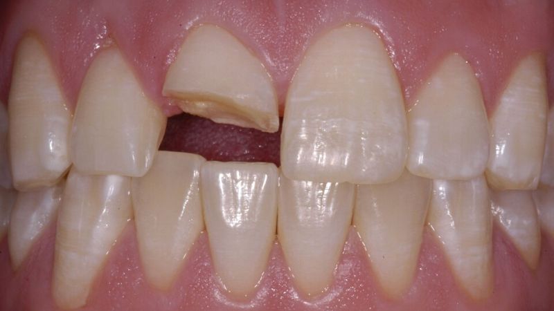 Răng sứ chất lượng thấp